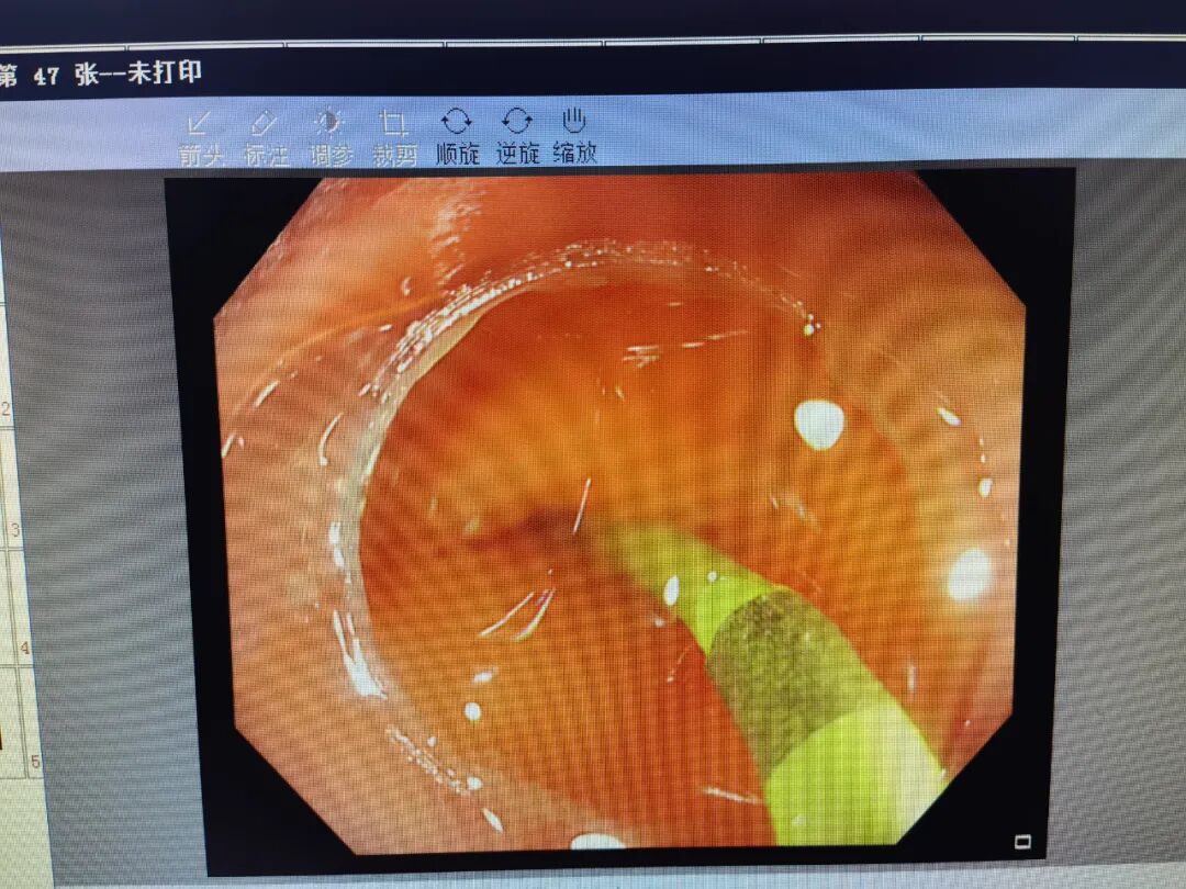 斑马导丝是治疗什么的【新技术】阑尾炎也可以不开刀：全市首例内镜逆行性阑尾炎治疗术（ERAT）+阑尾子镜+阑尾支架置入术_https://www.jmylbn.com_新闻资讯_第8张