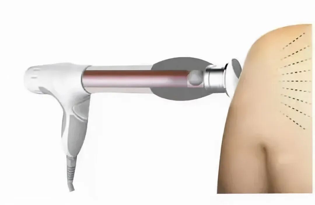 冲击波治疗效果怎么样冲击波疗法作用部位精准高效、方法简单治疗疼痛的首选方式！_https://www.jmylbn.com_新闻资讯_第4张