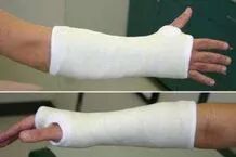 为什么骨折以前打个石膏，现在却要病人“遭罪”打钢板？