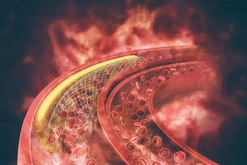 球囊怎么取出来血管里的斑块能取出来吗？心脏支架放进去，斑块去哪了？药物球囊和支架，哪个更好？_https://www.jmylbn.com_新闻资讯_第4张