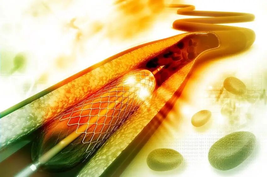 球囊怎么取出来血管里的斑块能取出来吗？心脏支架放进去，斑块去哪了？药物球囊和支架，哪个更好？_https://www.jmylbn.com_新闻资讯_第8张