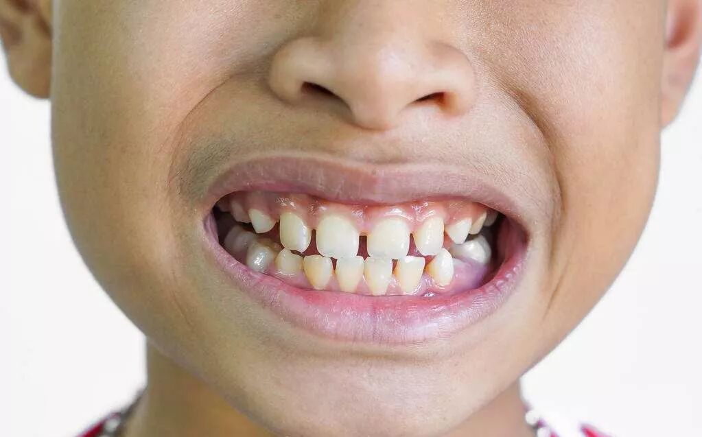 蛀牙对小孩的影响，家长都选择无视？