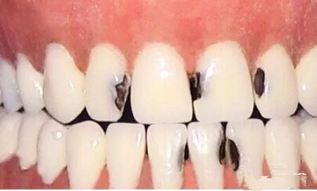 蛀牙对小孩的影响，家长都选择无视？