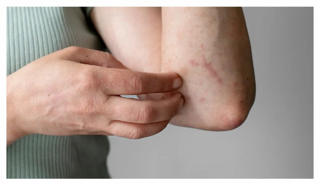 2025麻疹疫情爆發！快速掌握麻疹症狀與預防方法