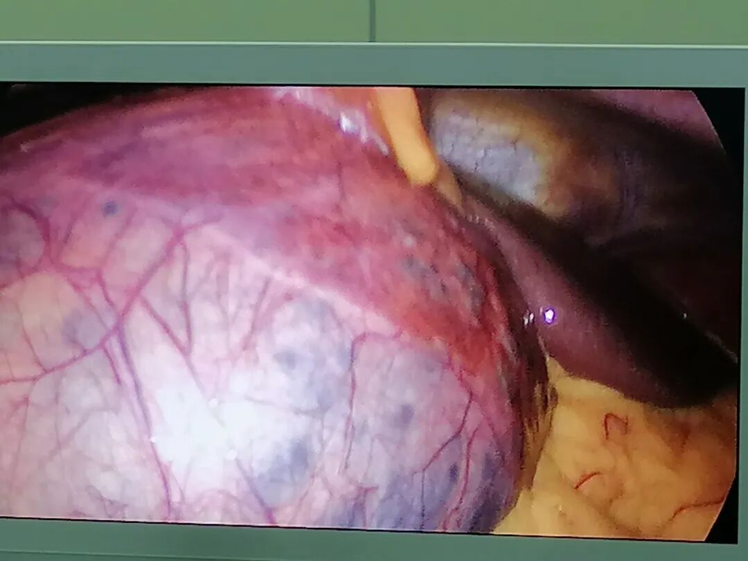 开刀孔怎么开刀【病例分享】不开刀，三个小孔搞定直径约20cm的巨大肝囊肿！_https://www.jmylbn.com_新闻资讯_第3张