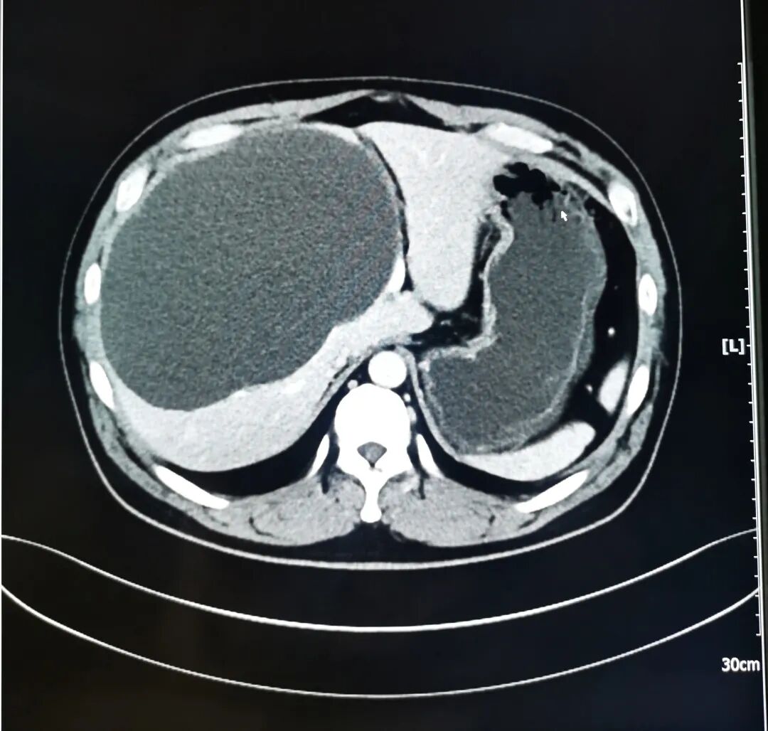 开刀孔怎么开刀【病例分享】不开刀，三个小孔搞定直径约20cm的巨大肝囊肿！_https://www.jmylbn.com_新闻资讯_第1张