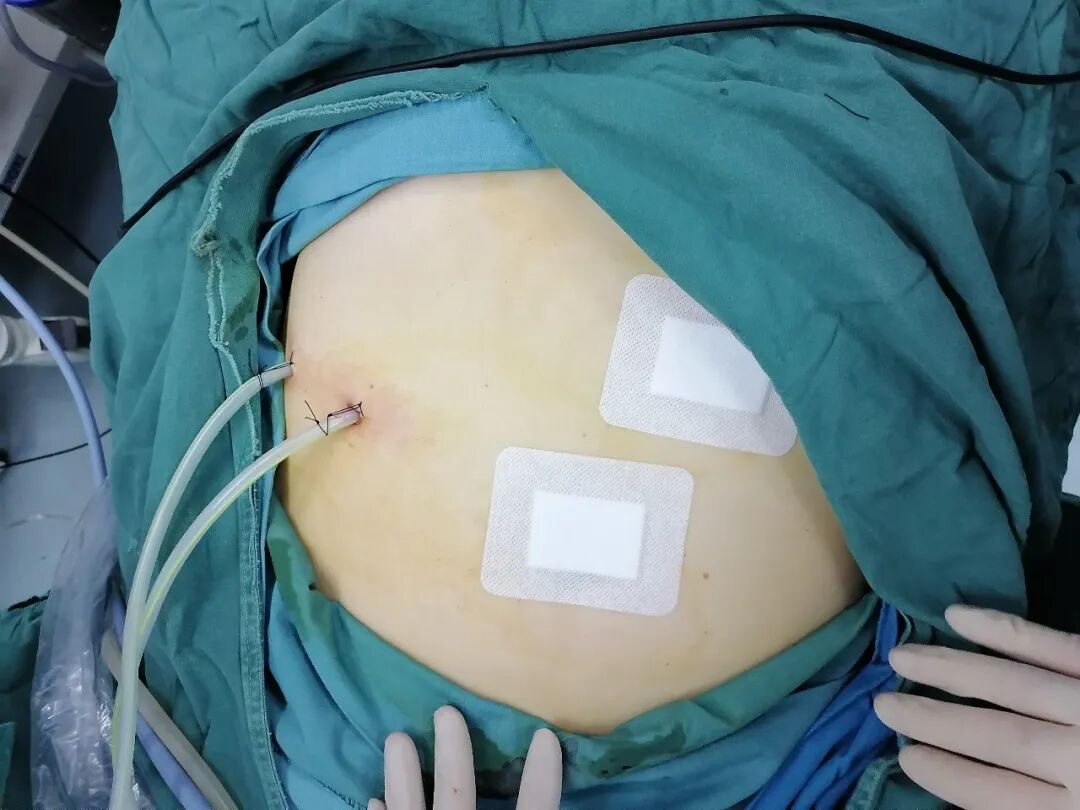 开刀孔怎么开刀【病例分享】不开刀，三个小孔搞定直径约20cm的巨大肝囊肿！_https://www.jmylbn.com_新闻资讯_第4张