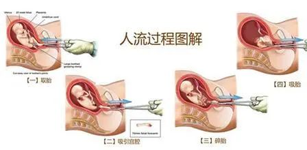 人工流产健康宣教