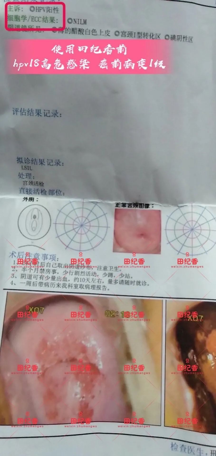 感染了HPV，癌前病变怎么办？