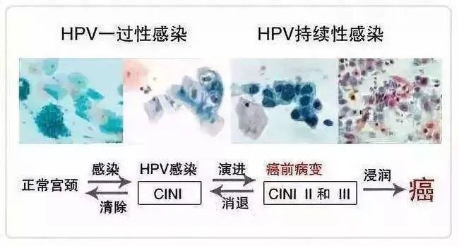 感染了HPV，癌前病变怎么办？