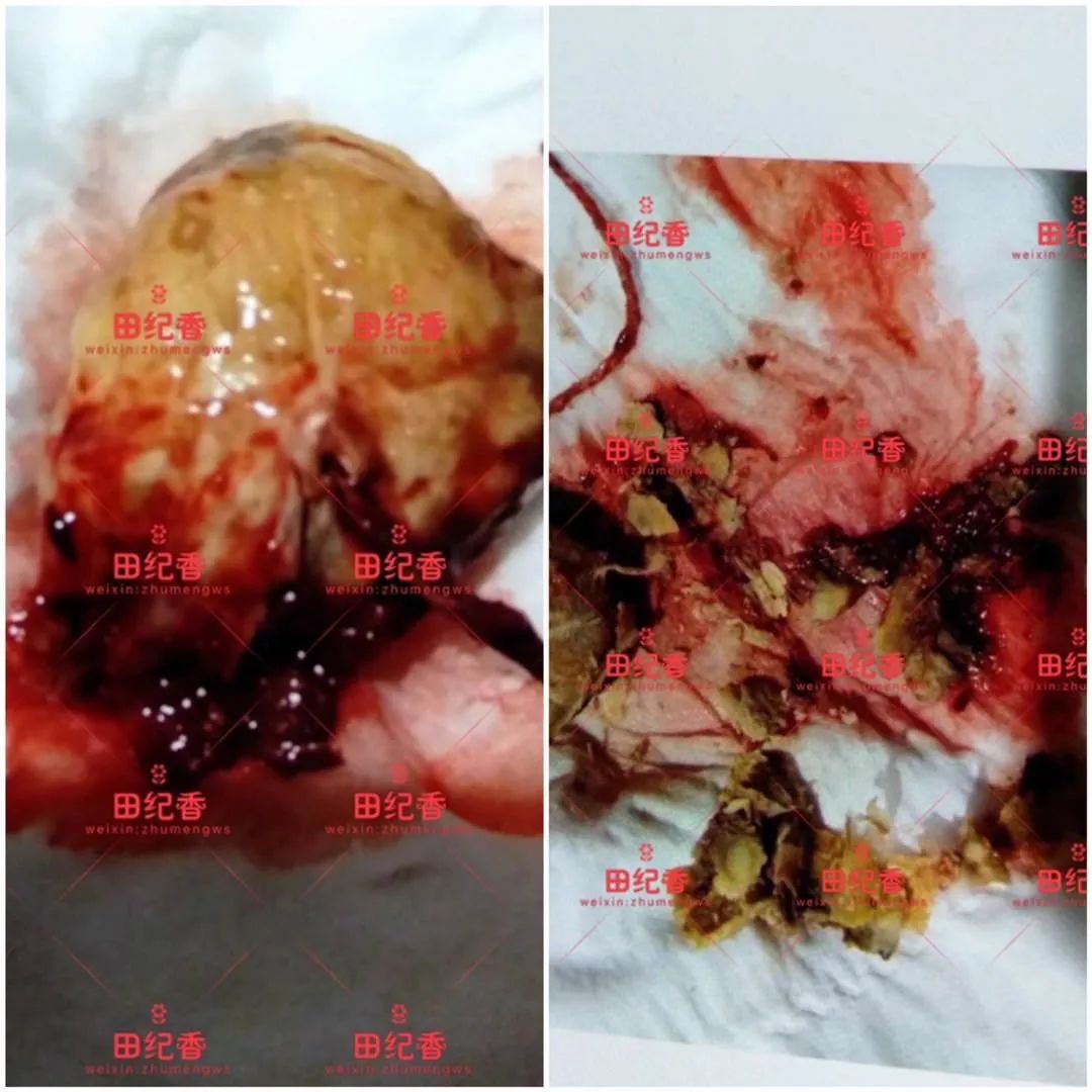 宫颈癌早期症状排泄物图片