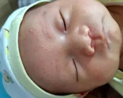 宝宝痤疮和湿疹的区别