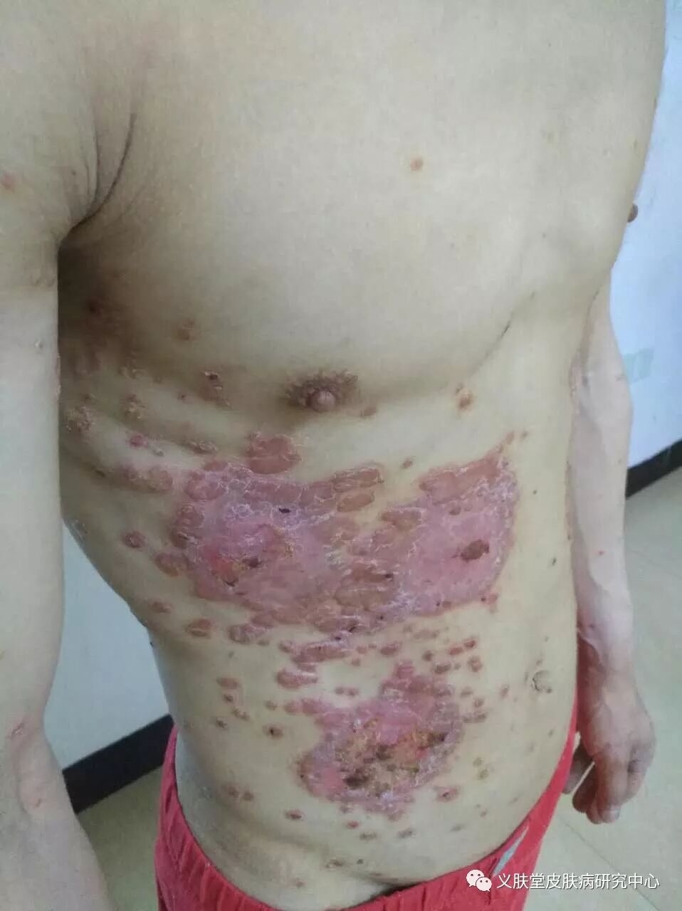 牛皮癣的克星——皮藓净+皮毒清，珠联璧合的好搭档