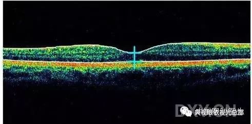 眼科经验贴 不同情况下的oct读图 爽视眼依视光总部 微信公众号文章阅读 Wemp