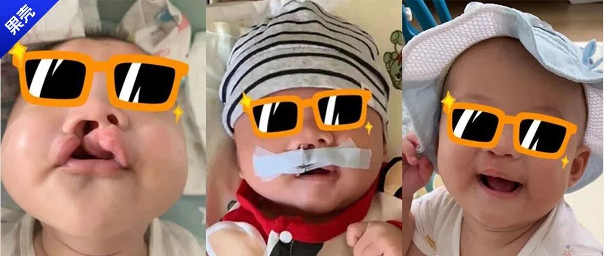 宝宝是一只“小兔子”，还没长牙就要开始正畸了