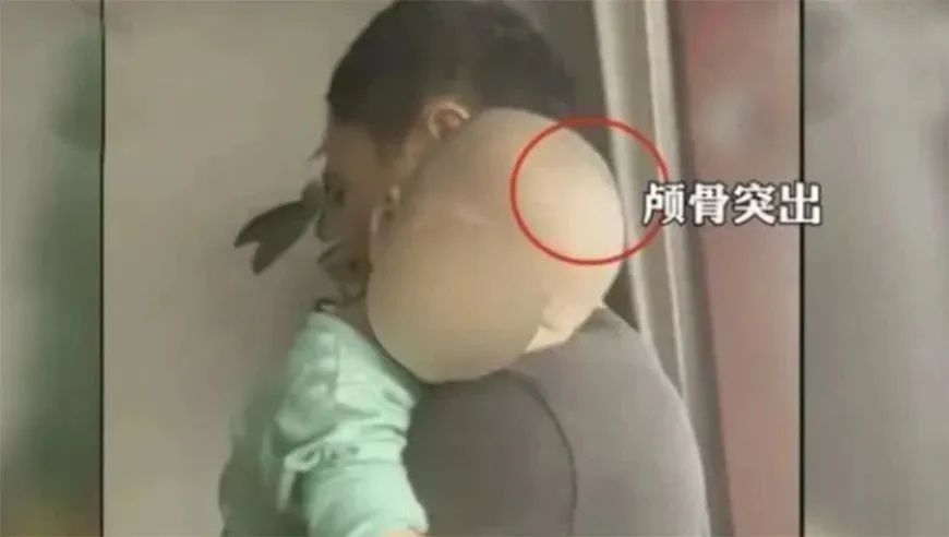 据媒体报道,湖南郴州永兴县多名患者家长投诉:自己的孩子颅骨突出成
