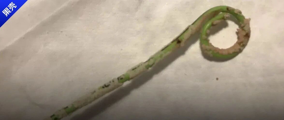 这根脏脏的管子上面，是我怀孕期间积累的结石