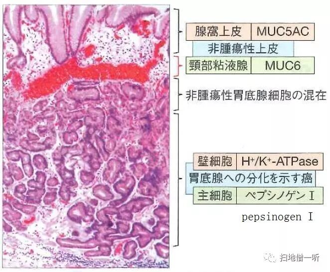 医学美图 胃 肠化の免疫组化基础 扫地僧一听 微信公众号文章阅读 Wemp