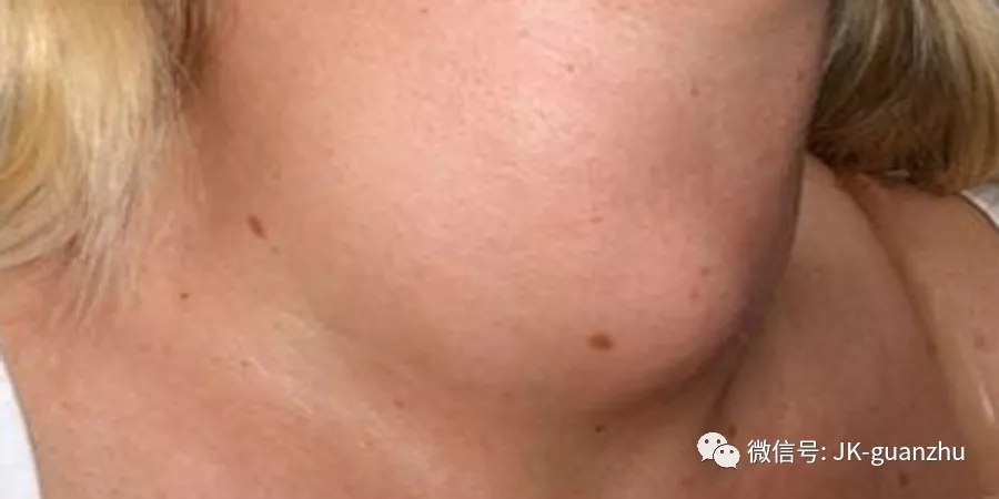 什么样的甲状腺结节要怀疑是癌?