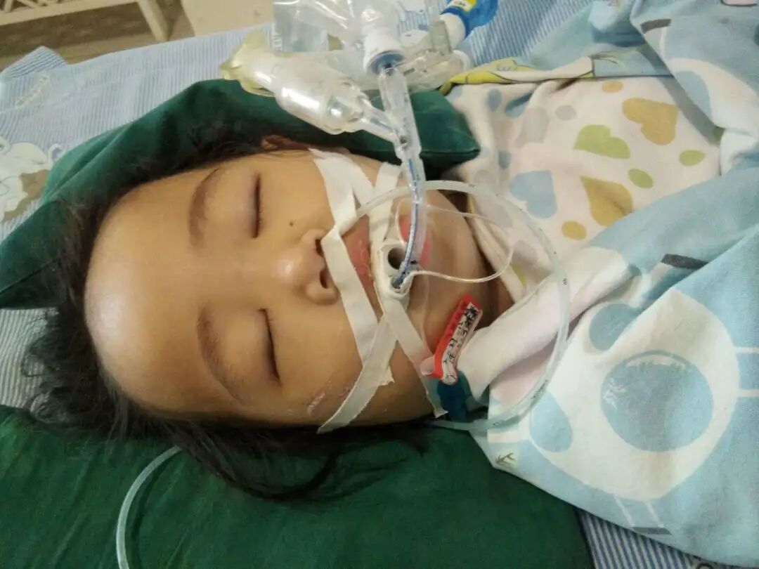 两岁女童患淋巴癌昏迷不醒,靠呼吸机维持生命,巨额医疗费没有着落