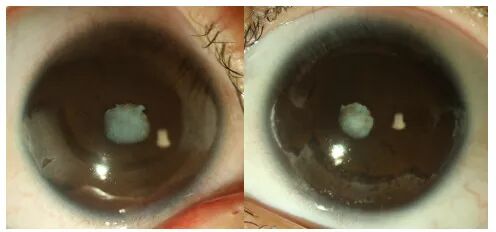 爱眼日知识科普长在眼睛上的云朵角膜带状变性
