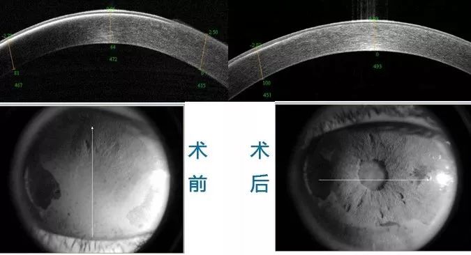 [爱眼日知识科普]长在眼睛上的云朵——角膜带状变性