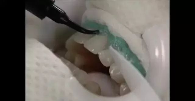 为什么牙医不用开口器刷屏朋友圈的冷光美牙仪，背后隐藏的风险你了解吗？_https://www.jmylbn.com_新闻资讯_第14张