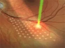 眼底激光机有什么牌子532眼底激光Visulas 532S——慧晶眼科高端设备（五）_https://www.jmylbn.com_新闻资讯_第19张