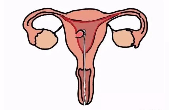 什么是宫腔组织吸引术我院计划生育科开展负压吸宫新方法——手动负压吸引流产术_https://www.jmylbn.com_新闻资讯_第2张