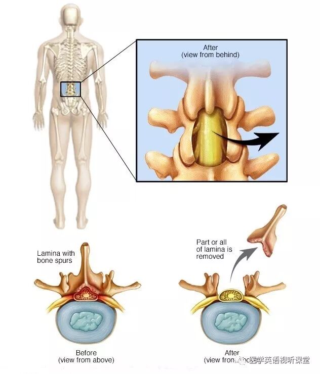 医学英语视听学习丨腰椎板切除术 医学英语视听课堂 微信公众号文章阅读 Wemp