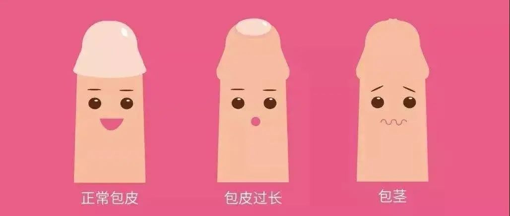 自我检查！你的包皮超标了吗？