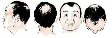 掉发还是脱发？简单3步，脱发自测
