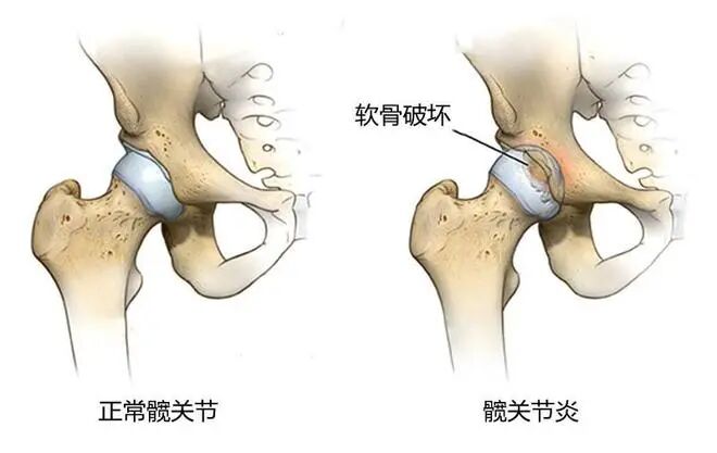 大腿根（腹股沟）疼痛：腰源性