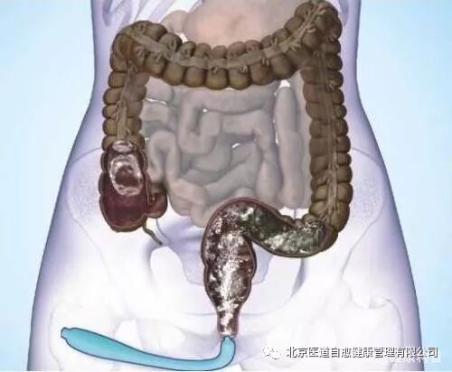 身体内的湿气是什么