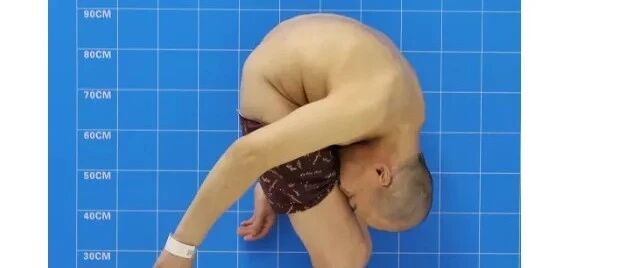 看一次哭一次！身体被敲断4次的“折叠人”出院了