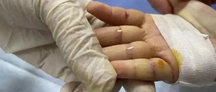 杭州2岁女童反复患肺炎，瘦成这副样子，爸爸说出一个“秘密”，妈妈绷不住了……