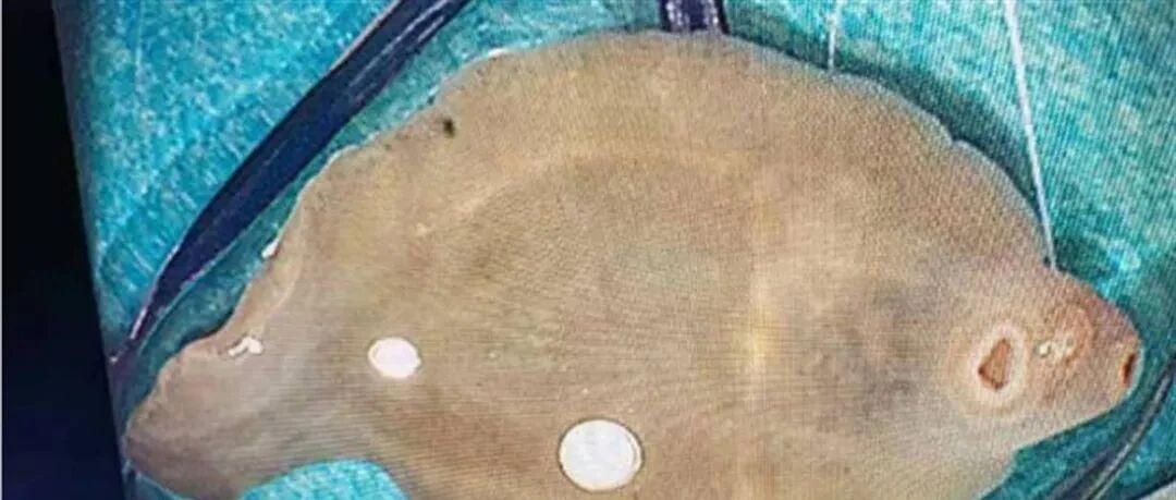 女子肝脏被吃掉三分之一，医生：“元凶”极为少见