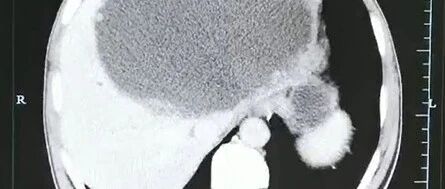 男子腹痛发烧，一查左肝已被……罪魁祸首竟是半年前的家常菜