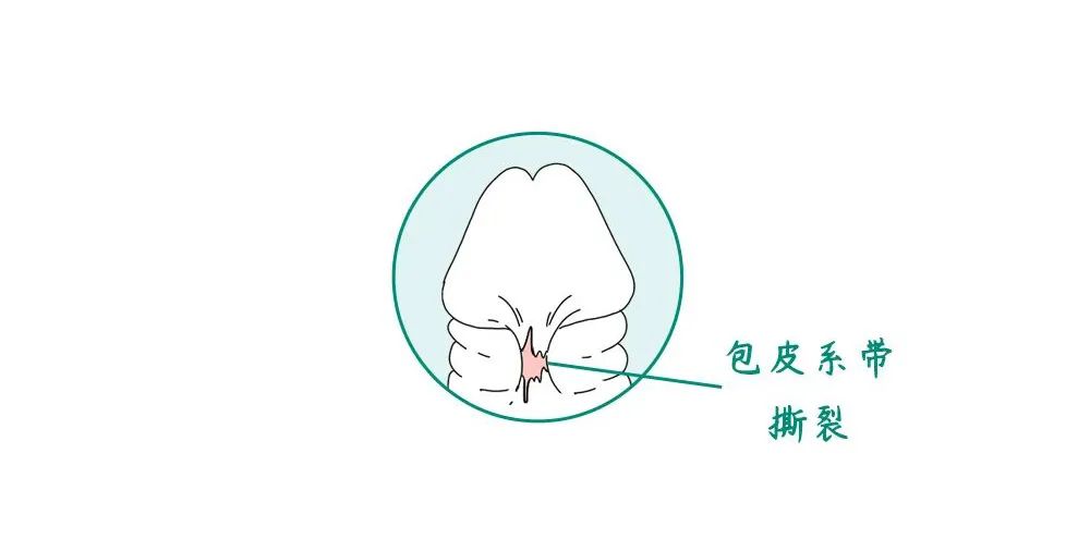 系带一旦发生断裂疼就不说了还会影响性生活的质量不过担心也没用医生只