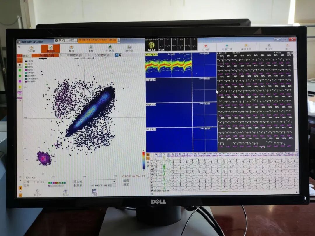 动态心电图怎么分析知识科普 ｜ 散点图在动态心电图分析中的重要作用_https://www.jmylbn.com_新闻资讯_第2张