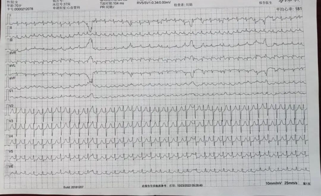 动态心电图怎么分析知识科普 ｜ 散点图在动态心电图分析中的重要作用_https://www.jmylbn.com_新闻资讯_第3张