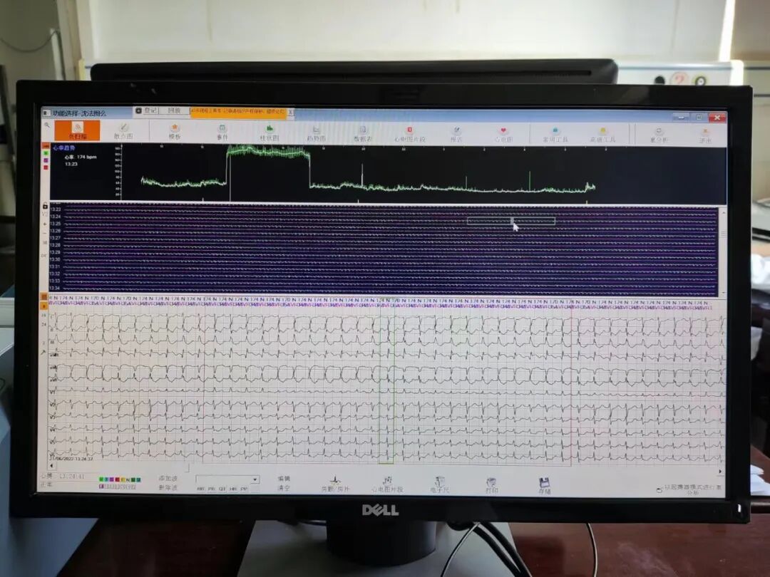 动态心电图怎么分析知识科普 ｜ 散点图在动态心电图分析中的重要作用_https://www.jmylbn.com_新闻资讯_第1张