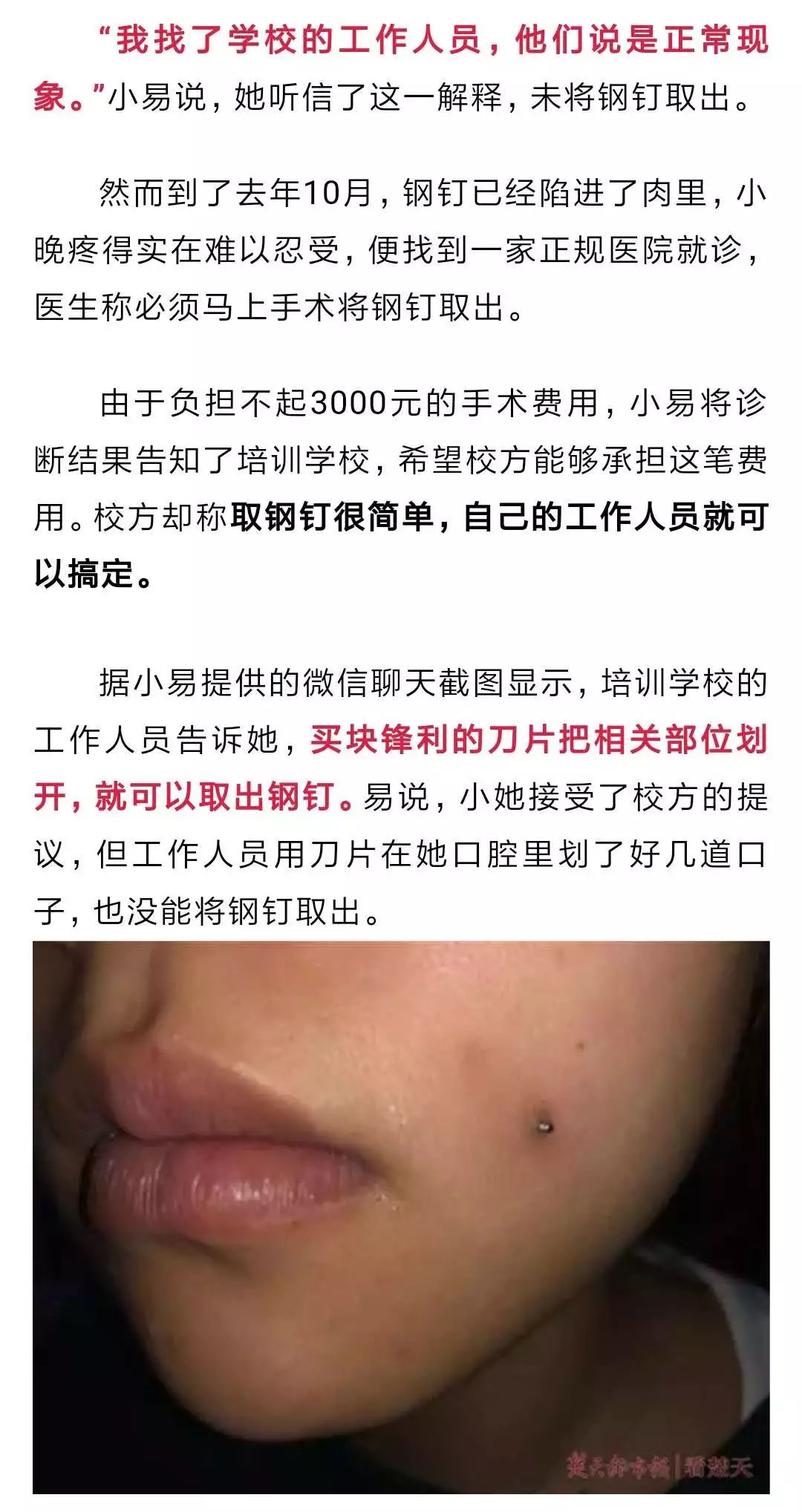 驚悚！為長出酒窩，19歲女孩在臉上打2根鋼釘！ 靈異 第3張