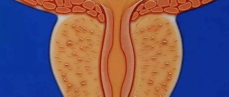 慢性前列腺炎，秋冬受凉就反复，因为你没找到病根儿！