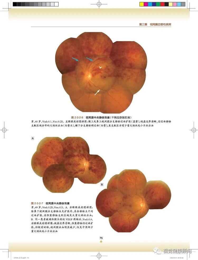 彩色眼底照相查什么一张眼底照片，可筛查出80%的眼病_https://www.jmylbn.com_新闻资讯_第11张