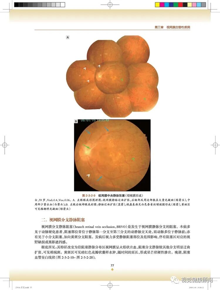 彩色眼底照相查什么一张眼底照片，可筛查出80%的眼病_https://www.jmylbn.com_新闻资讯_第13张