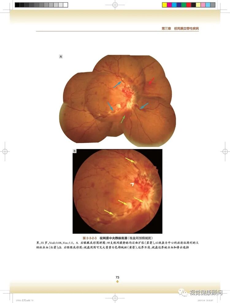 彩色眼底照相查什么一张眼底照片，可筛查出80%的眼病_https://www.jmylbn.com_新闻资讯_第9张