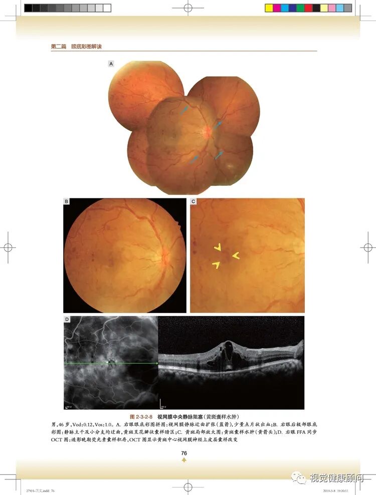 彩色眼底照相查什么一张眼底照片，可筛查出80%的眼病_https://www.jmylbn.com_新闻资讯_第12张