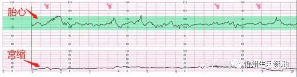 什么是胎儿监护胎心监护怎么看？什么情况下孕妈需要做胎心监护？_https://www.jmylbn.com_新闻资讯_第6张