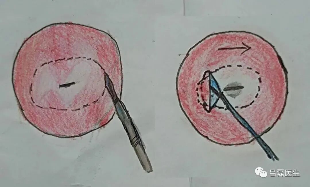 电切环怎么连接导线宫颈锥切术与LEEP术，优缺点是什么？哪个效果更好？（附具体操作方法）_https://www.jmylbn.com_新闻资讯_第3张